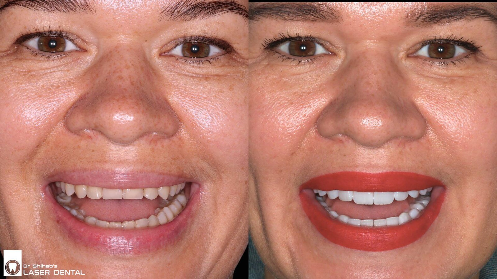 Laser Dental