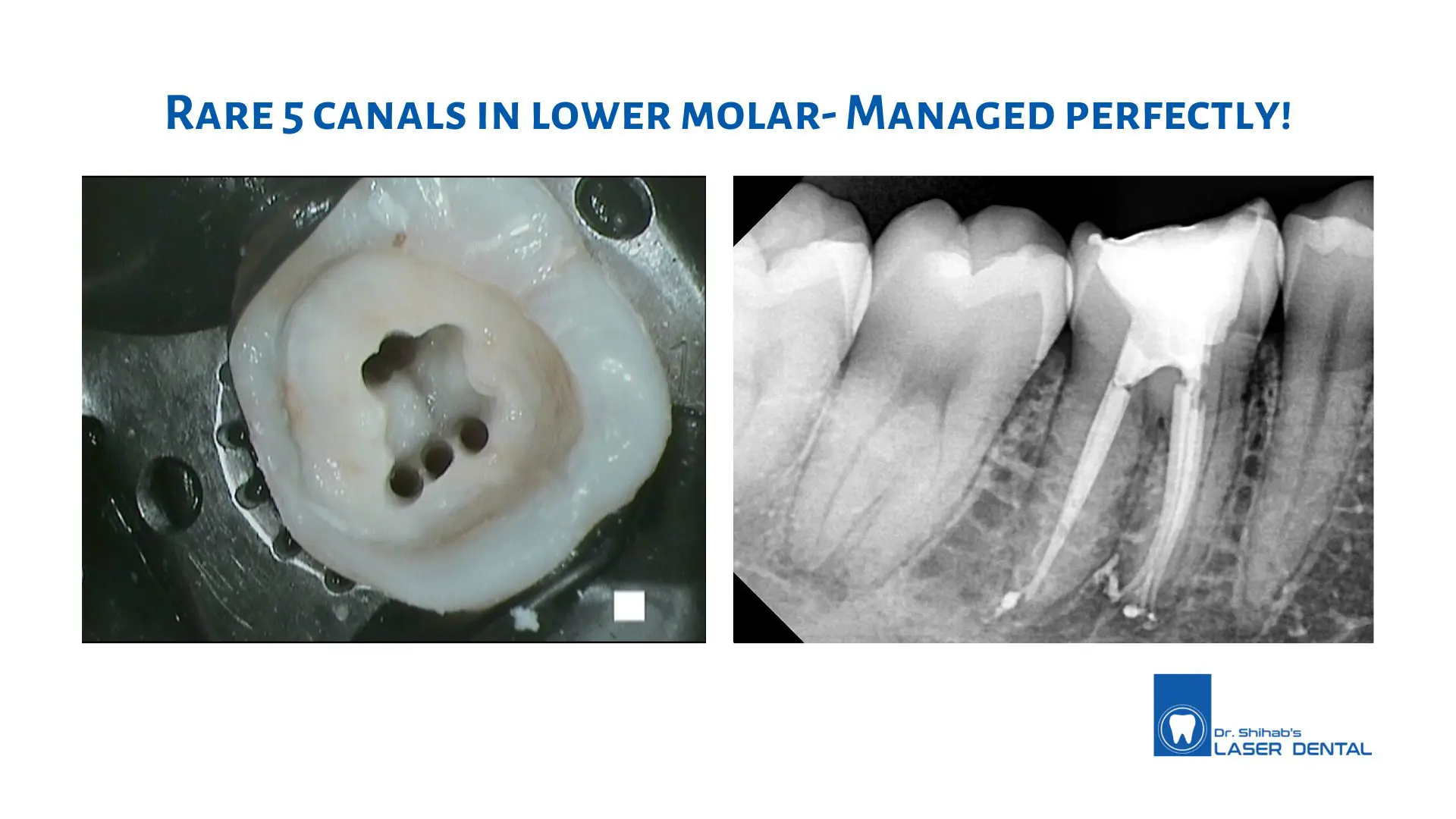 Laser Dental