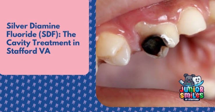 SDF Application with fluoride varnish