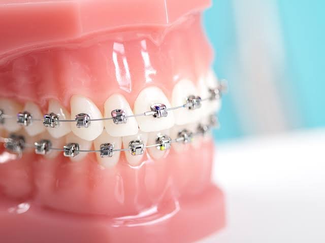 Fixed Braces