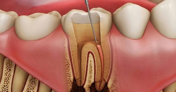 Re-Root Canal Treatment