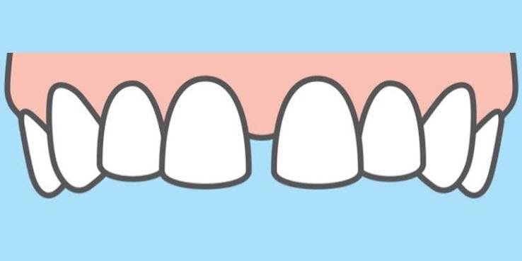 Midline Diastema Closure