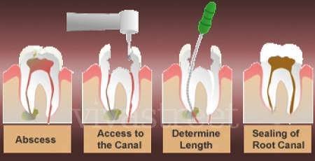 Single visit root canal
