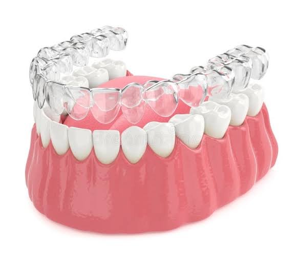 Clear Aligners