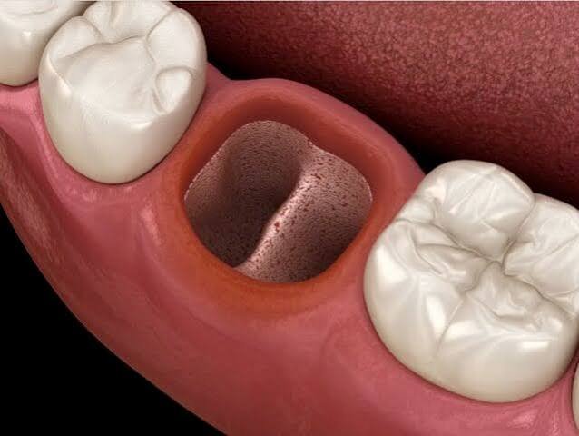 Dry Socket Management