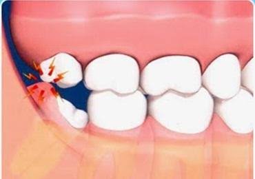 Operculectomy