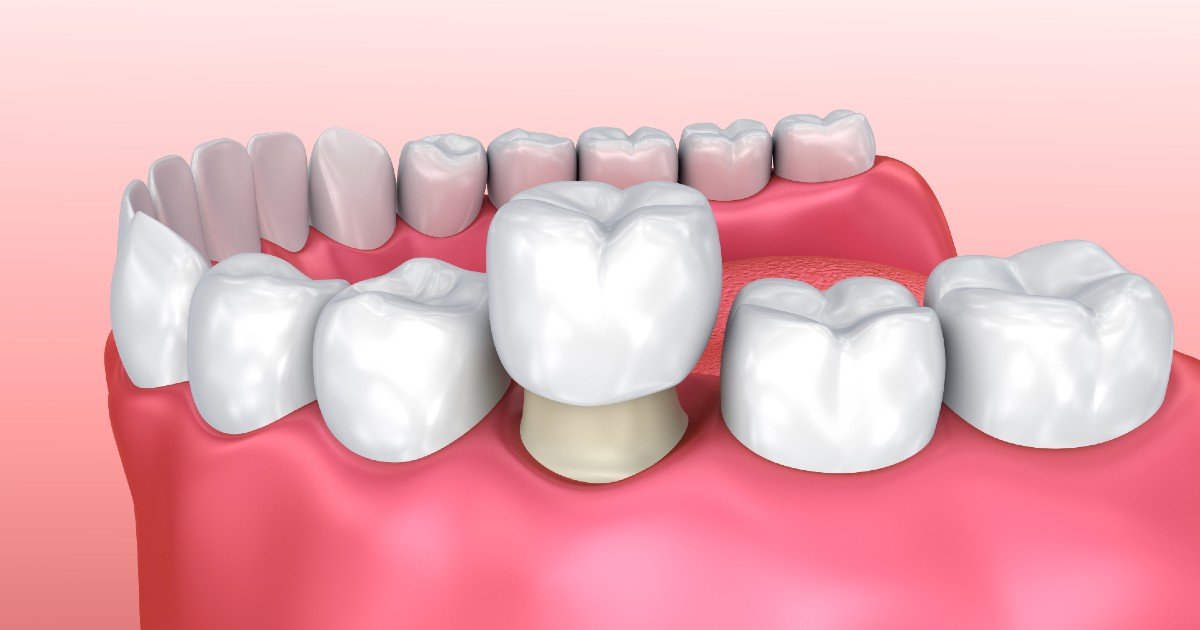 Crown Recementation