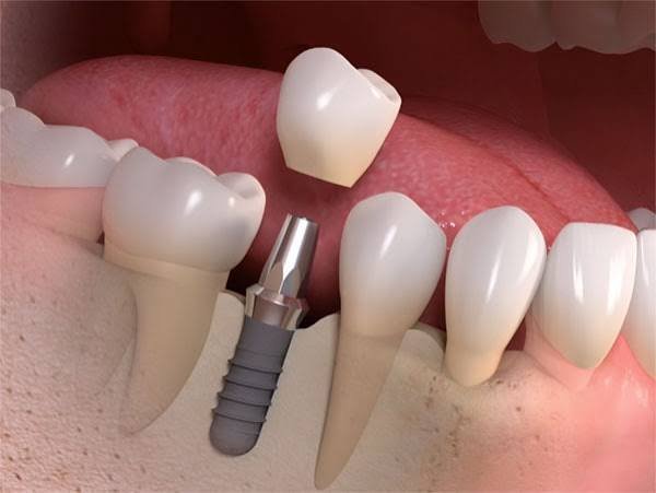 Dental implant with crown