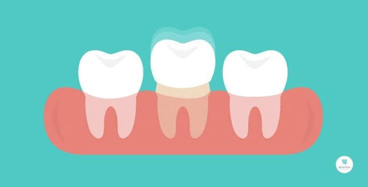 Crown Removal