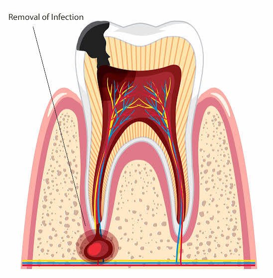 Apiceoctomy