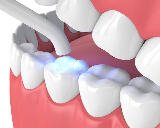 Light cure composite filling posterior