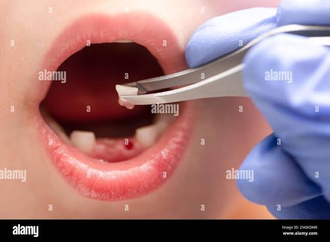 Milk tooth extraction