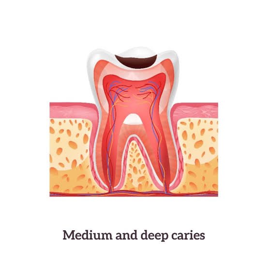 Vital Pulp Capping