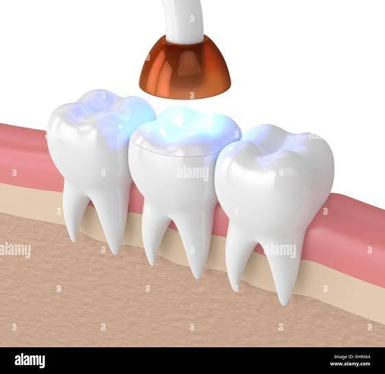 Light cure filling
