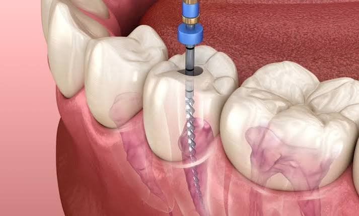 Pulpectomy