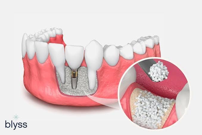 Bone graft